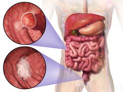 Cancro colorrectal / Blausen Medical Communications, Inc. - Wikimedia - Arquivo