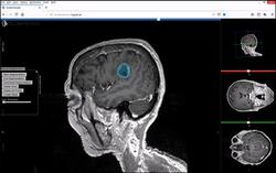 Tumor cerebral / EmmaWiki2020 - Wikimedia.
