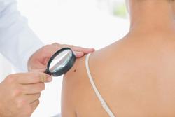 Arquivo - Lunares, cancro de pel, melanoma. WAVEBREAKMEDIA LTD - Arquivo / Europa Press